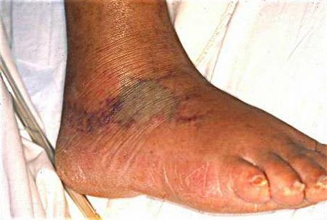 Λοίμωξη Vibrio vulnificus