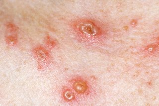 Μικρές κόκκινες κηλίδες με κηλίδες στο κέντρο, σε λευκό δέρμα.