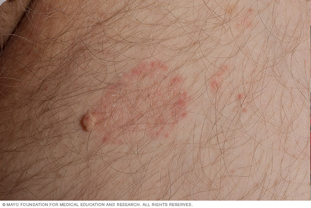 Tinea cruris: συμπτώματα, αιτίες και θεραπεία