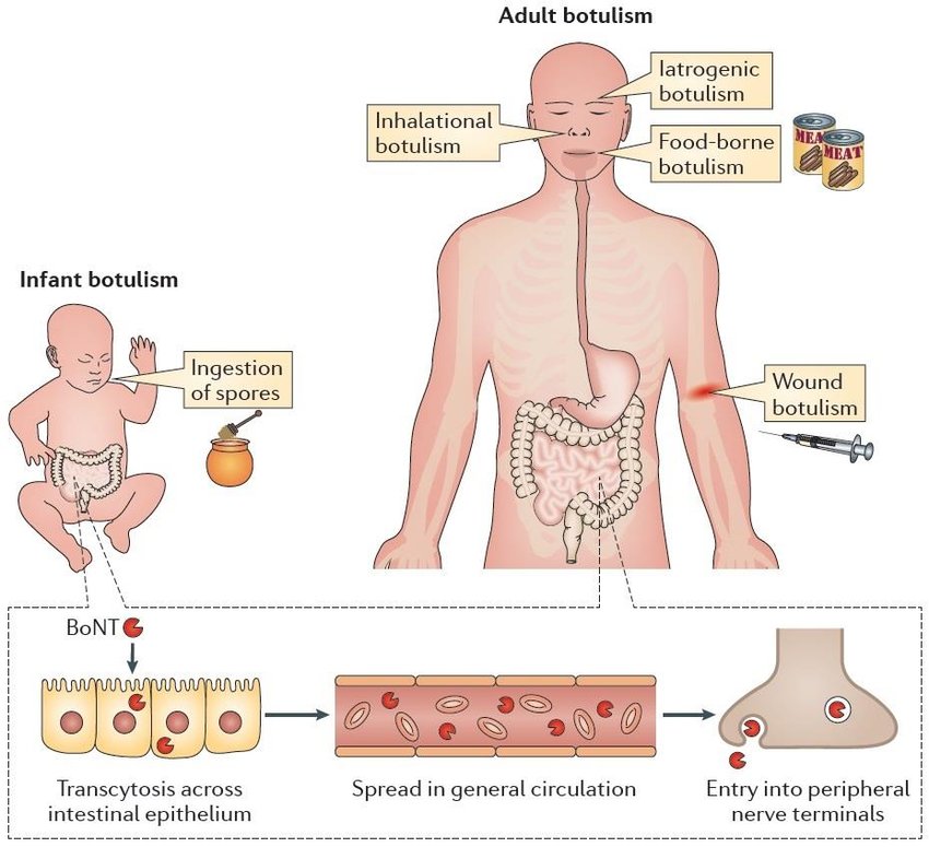 https://www.researchgate.net/profile/Cedric_Woudstra/publication/304792202/figure/fig2/AS:380429820547074@1467712945210/Human-form-of-botulism-Intoxination-due-to-consumption-of-food-contaminated- με.png