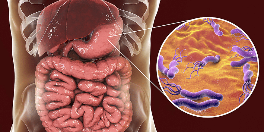 Μόλυνση από βακτηρίδια Helicobacter pylori (H. pylori) Μόλυνση από βακτηρίδια Helicobacter pylori (H. pylori)