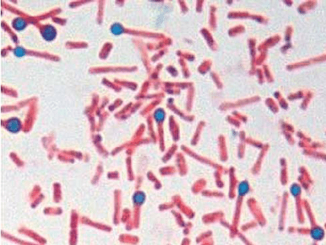 ένα. Σπόρια και βακτήρια του Clostridium tetani με τυπικό σχήμα τυμπάνου που απομονώνονται από την κρούστα των ξηρών πληγών στην περίπτωση 1 (χρώση γραμμάριο-1000x).
