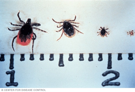 Νόσος του Lyme – αιτίες, συμπτώματα και θεραπεία Νόσος του Lyme – αιτίες, συμπτώματα και θεραπεία