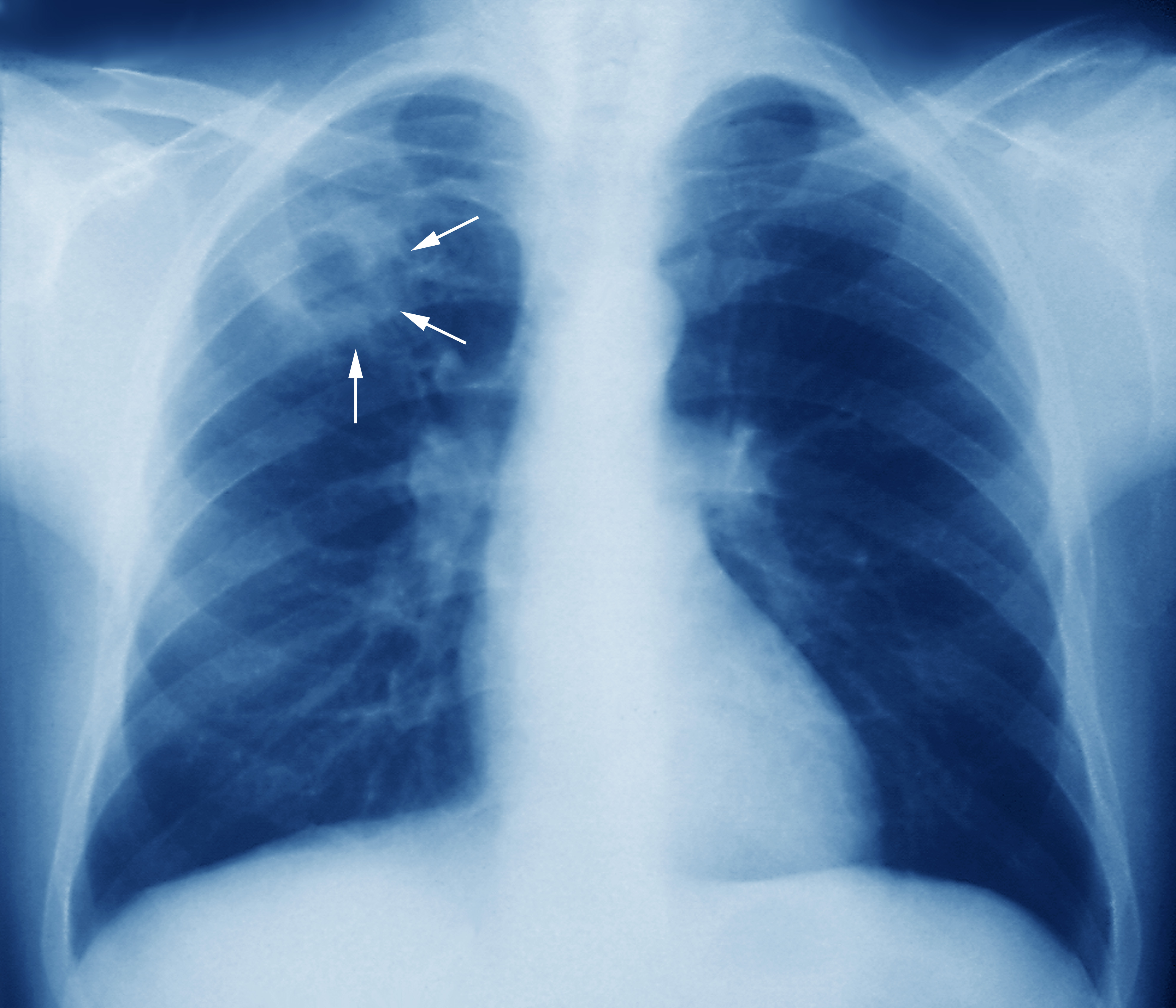 https://www.merckmanuals.com/-/media/manual/professional/images/m2700245- tuberculosis-chest-x-ray-science-photo-library-high.jpg