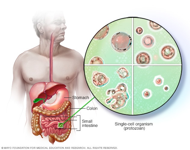 Blastocystis hominis – αιτίες, συμπτώματα και θεραπεία