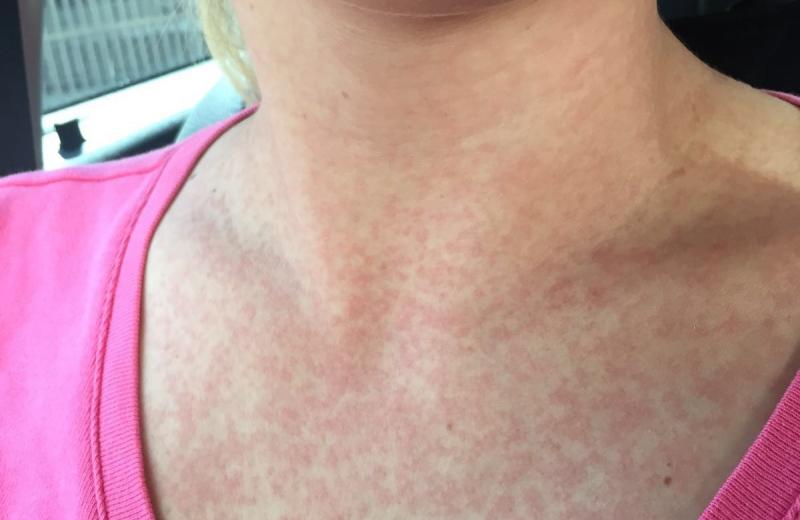 Εξάνθημα από δάγκειο πυρετό